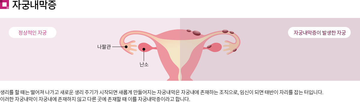 자궁내막증 : 생리를 할 때는 떨어져 나가고 새로운 생리 주기가 시작되면 새롭게 만들어지는 자궁내막은 자궁내에 존재하는 조직으로, 임신이 되면 태반이 자리를 잡는 터입니다. 이러한 자궁내막이 자궁내에 존재하지 않고 다른 곳에 존재할 때 이를 자궁내막증이라고 합니다.